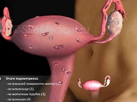 Эндометриоз – как можно вылечить | Клиника «Центр ЭКО» в Пскове