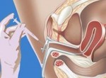 ЭКО в естественном цикле в Пскове ЭКО в естественном цикле в Пскове